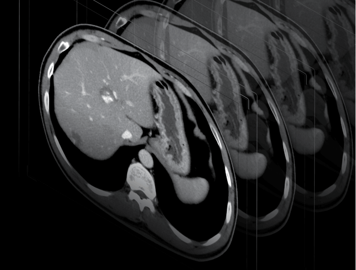 KARL 3D Iterative Denoising