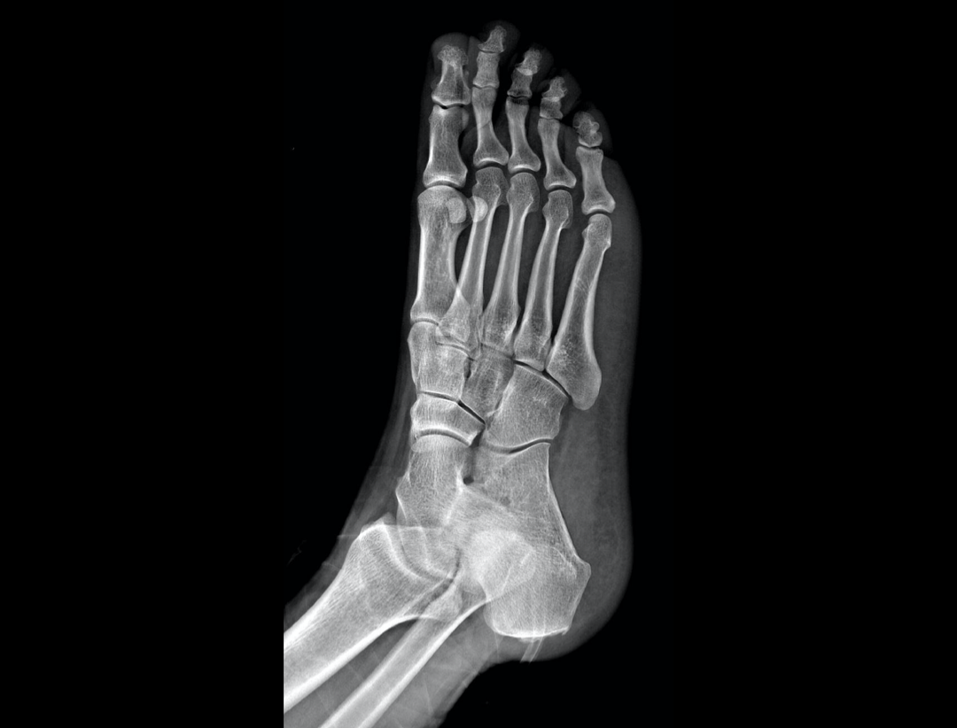 Foot AP Oblique