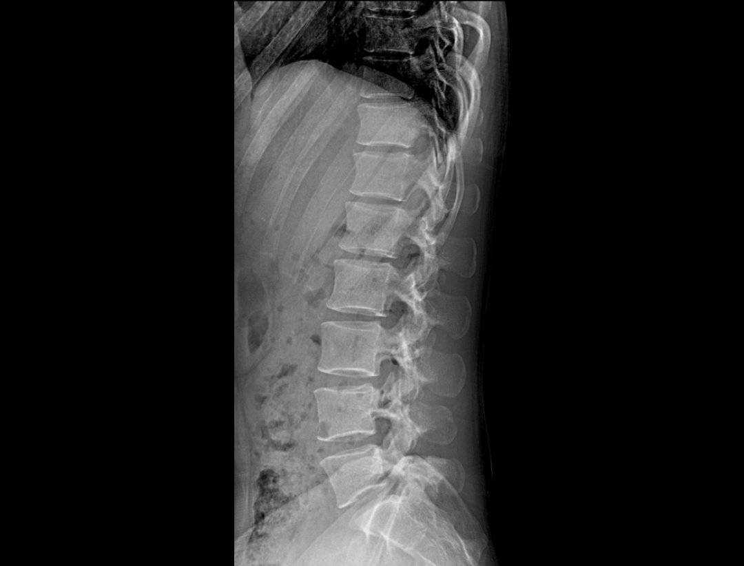spine imaging with Integrated vertebral Cobb angle and femoral collo-diaphyseal angle measurement