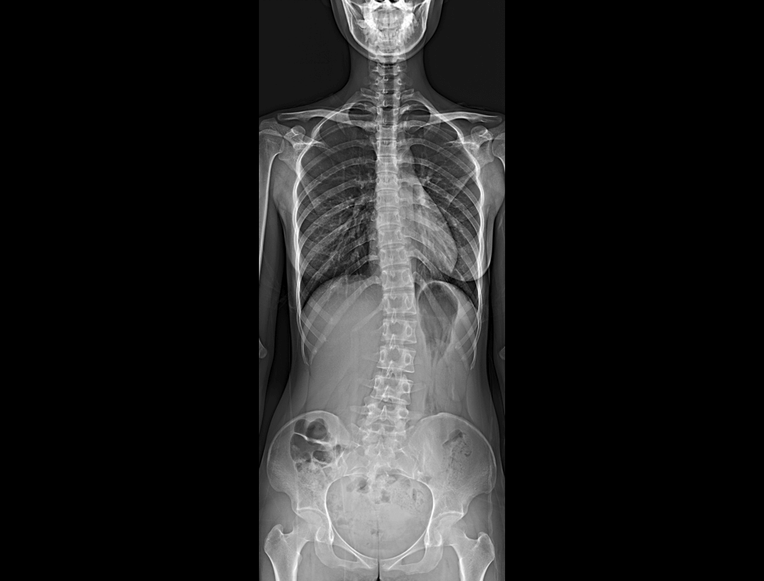 body imaging with Automatic Stitching Technology*