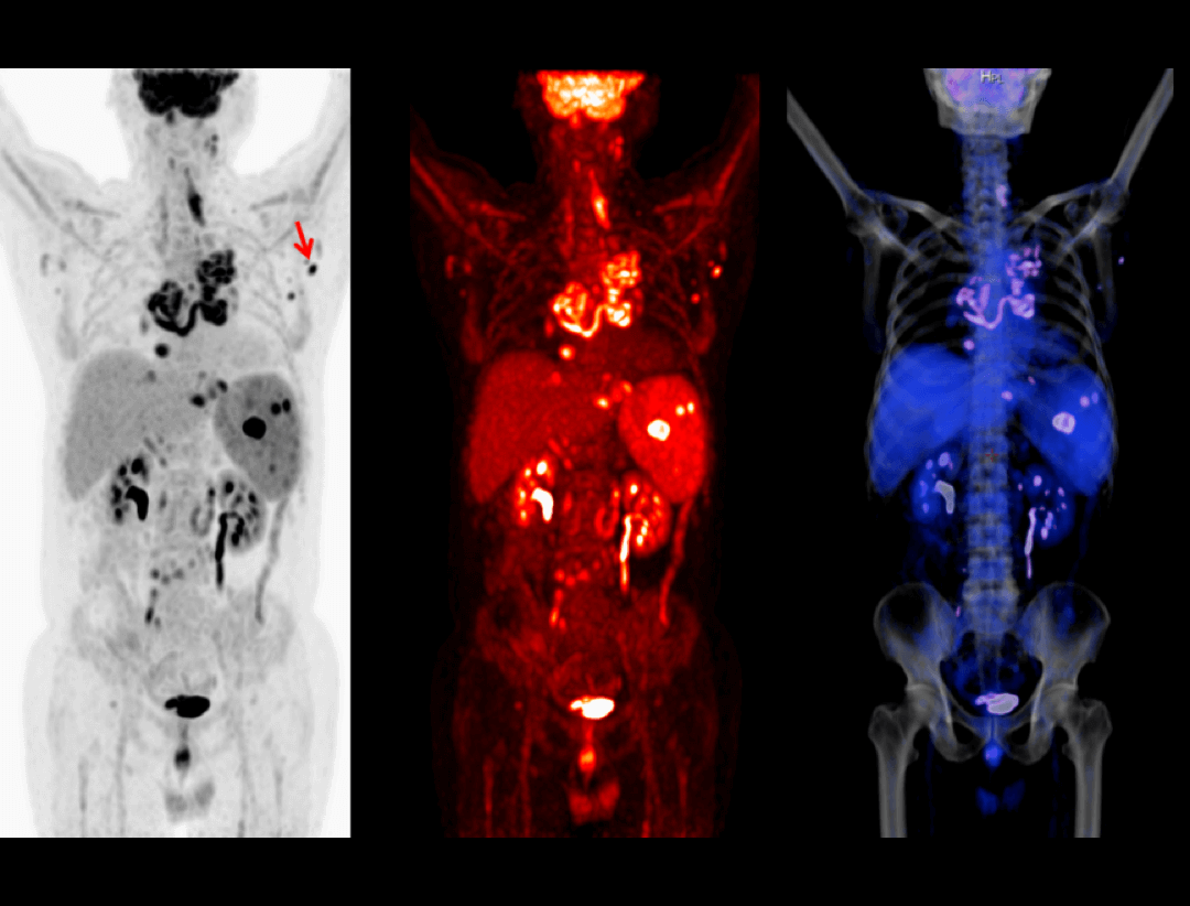 imaging of Lymphoma with colors in white, red and blue