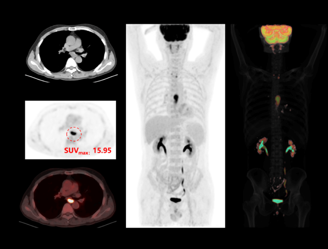 imaging of Esophagus Cancer showing different colors