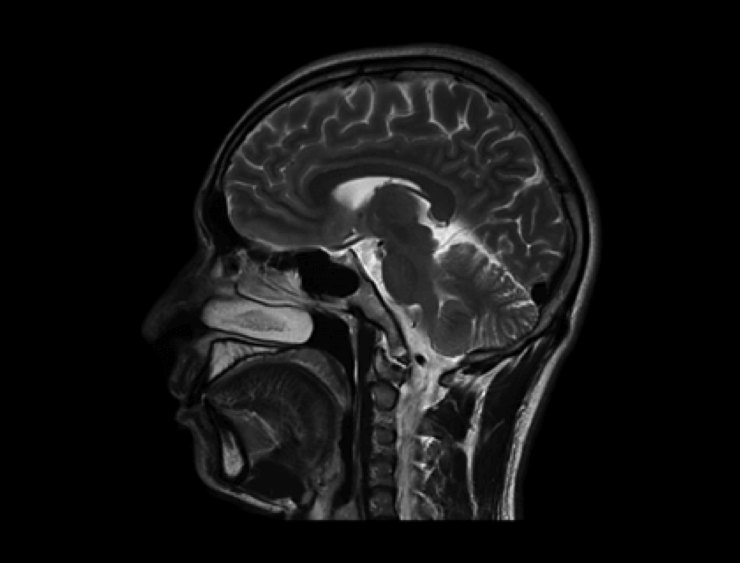 imaging of ARMS