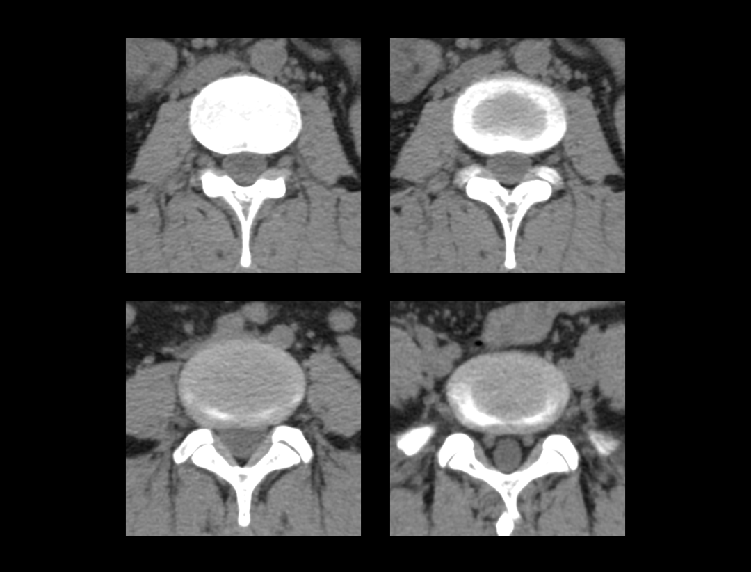 L-spine Scan