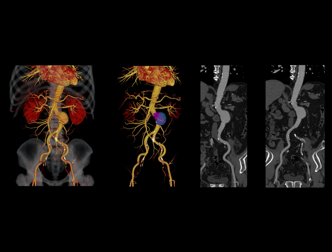 Arterial Aneurysm