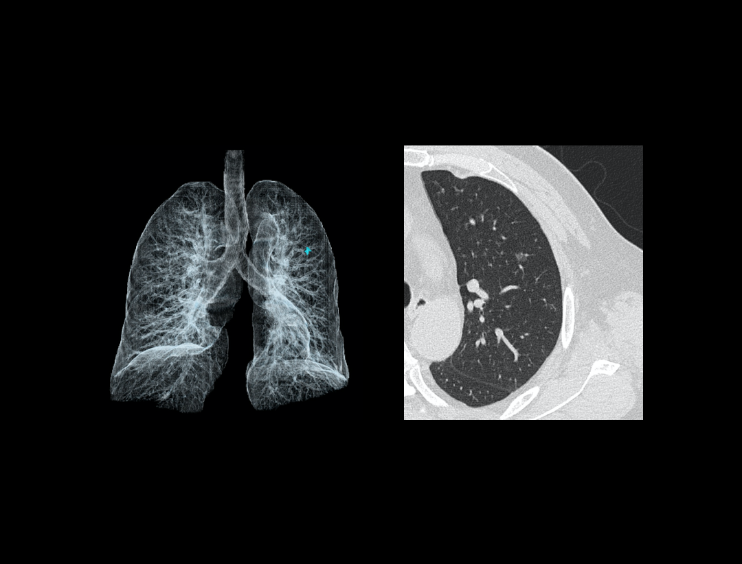Pulmonary Nodule