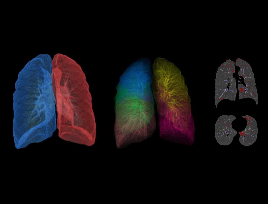 Pulmonary Emphysema 