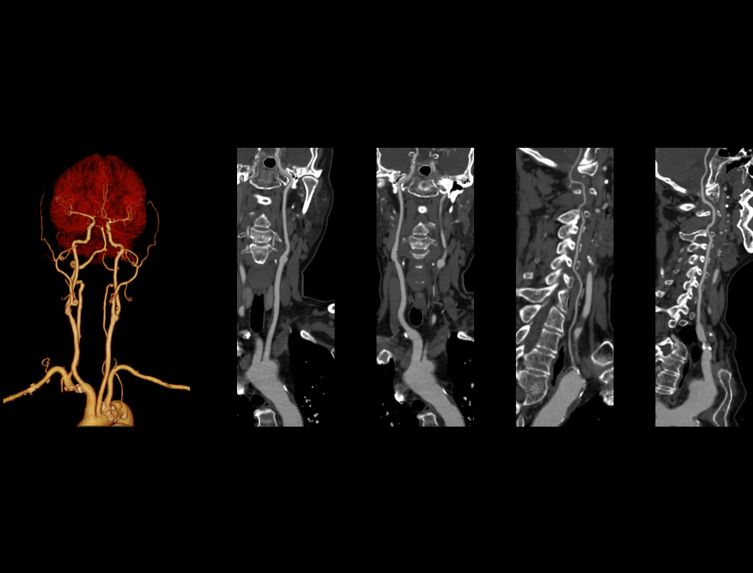 Carotid CTA