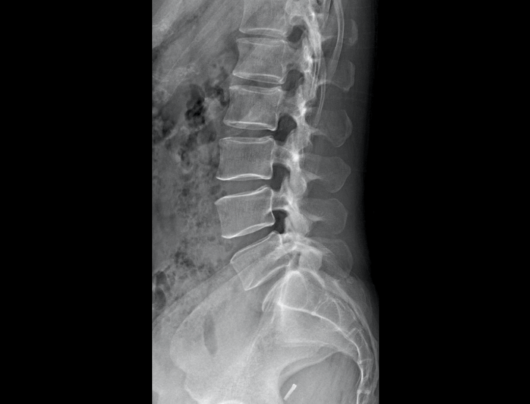 Lumber Vertebrae LAT