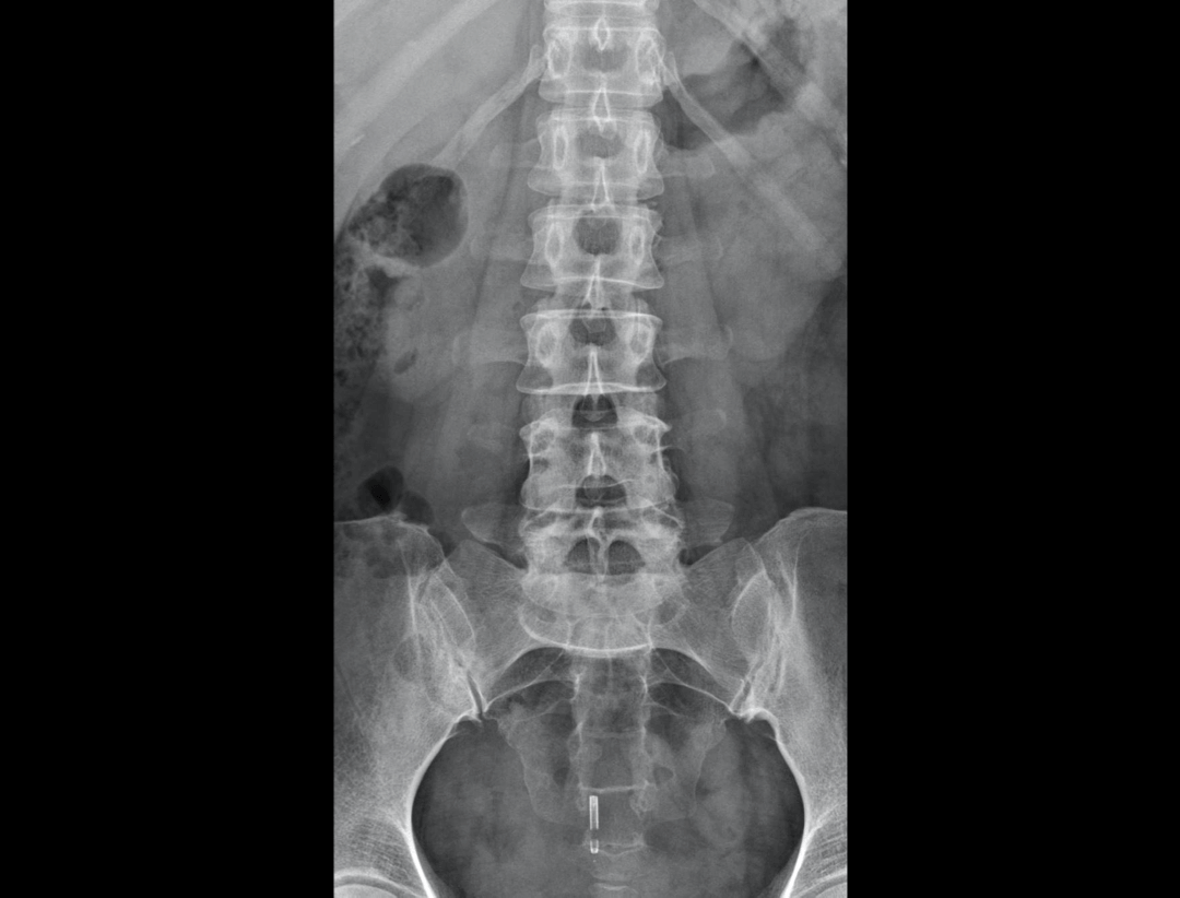 Lumber Vertebrae AP