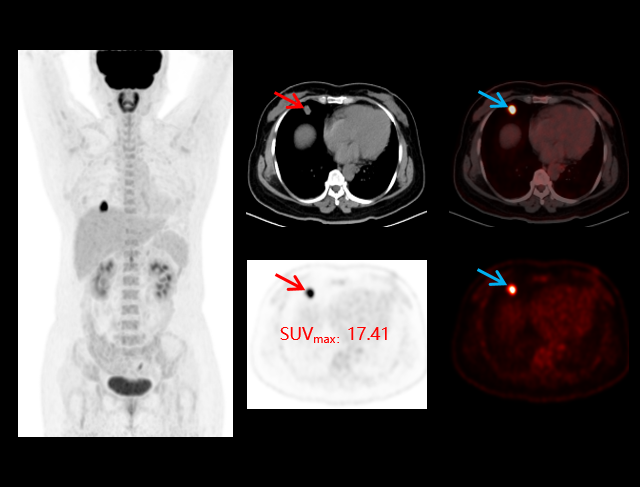imaging for lung cancer segmenting and analyzing the separately obtained area