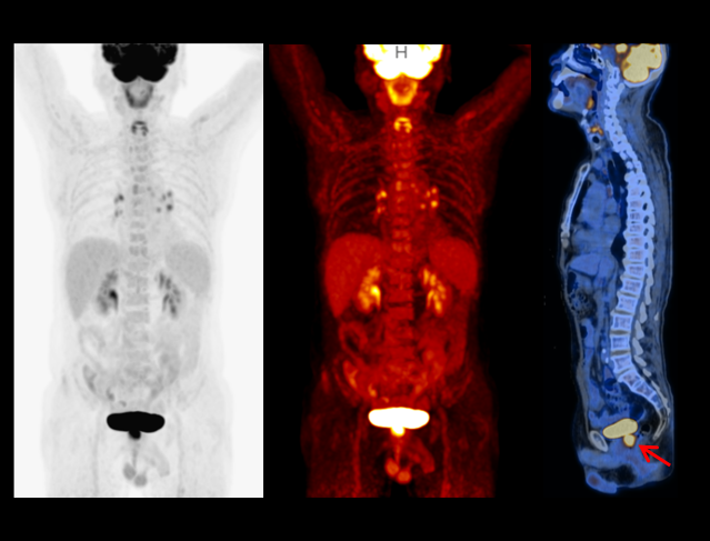 imaging for Rectal Cancer with colors in white, red and blue