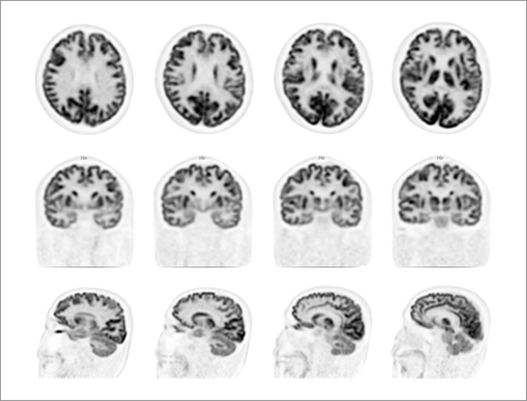 12 pieces of intercept and slope brain imaging