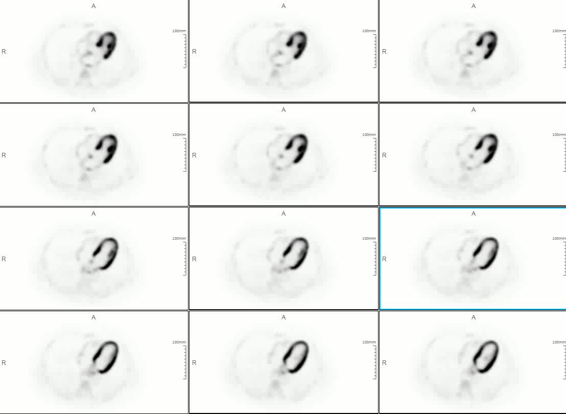 16 pieces of Cardiac Viability Imaging with motions 